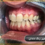 تغيير رنگ دندان تهران