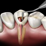 علل-عصب-کشی-دندان-چیست؟