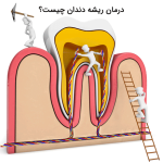 root-canal-therapy-01