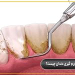 جرم گیری دندان چیست؟
