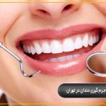 جرم گیری دندان در تهران