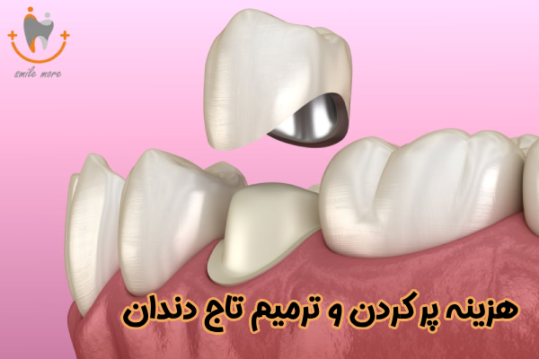 هزینه پر کردن و ترمیم تاج دندان