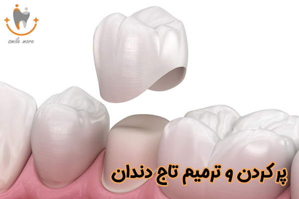 پر کردن و ترمیم تاج دندان