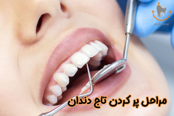 مراحل پر کردن تاج دندان