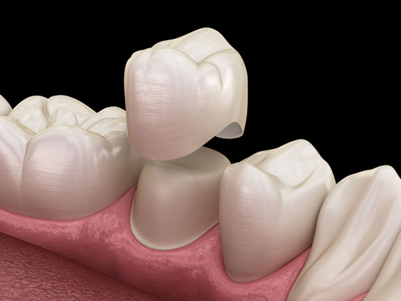 انواع روکش دندان