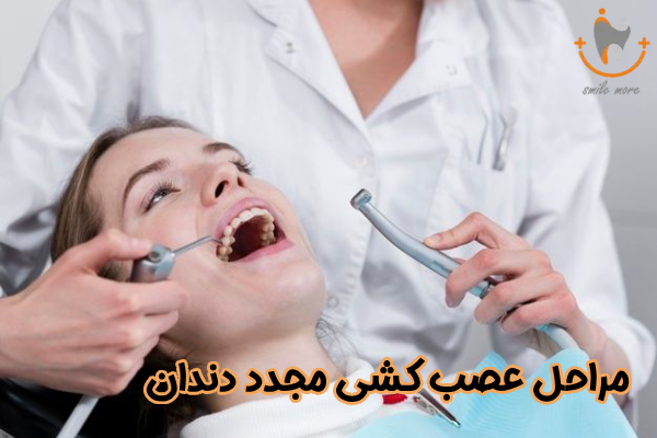 مراحل عصب کشی مجدد دندان