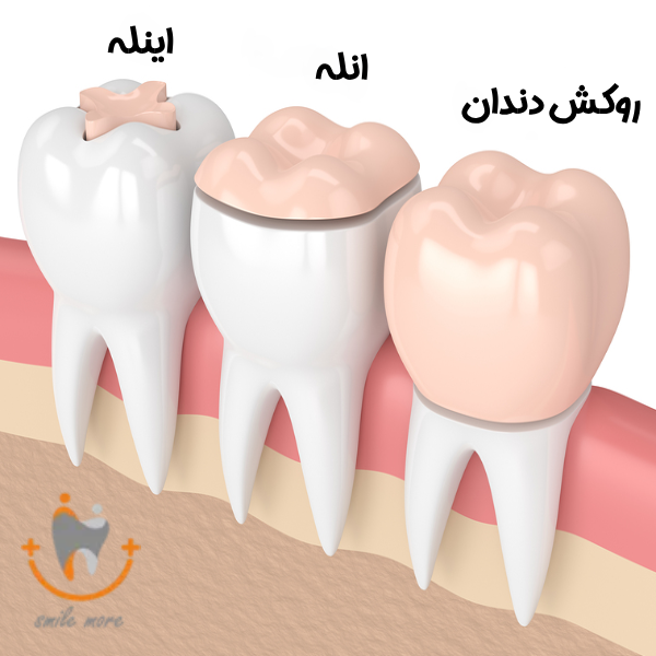 مراحل اینله و انله دندان