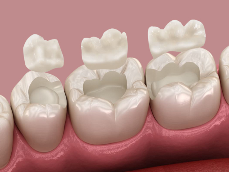 اینله و آنله دندان چیست