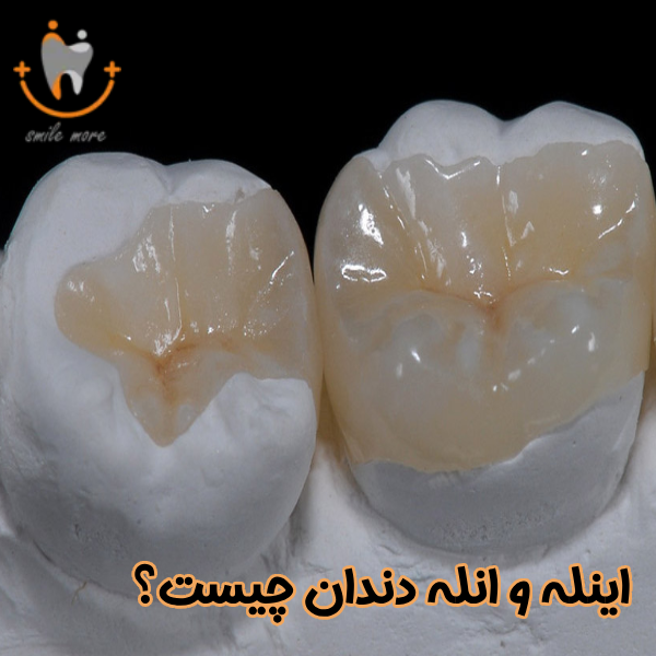 اینله و انله دندان چیست