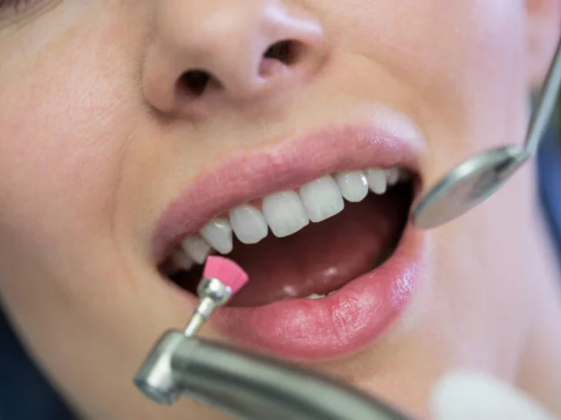 هزینه جرم گیری دندان ۱۴۰۴