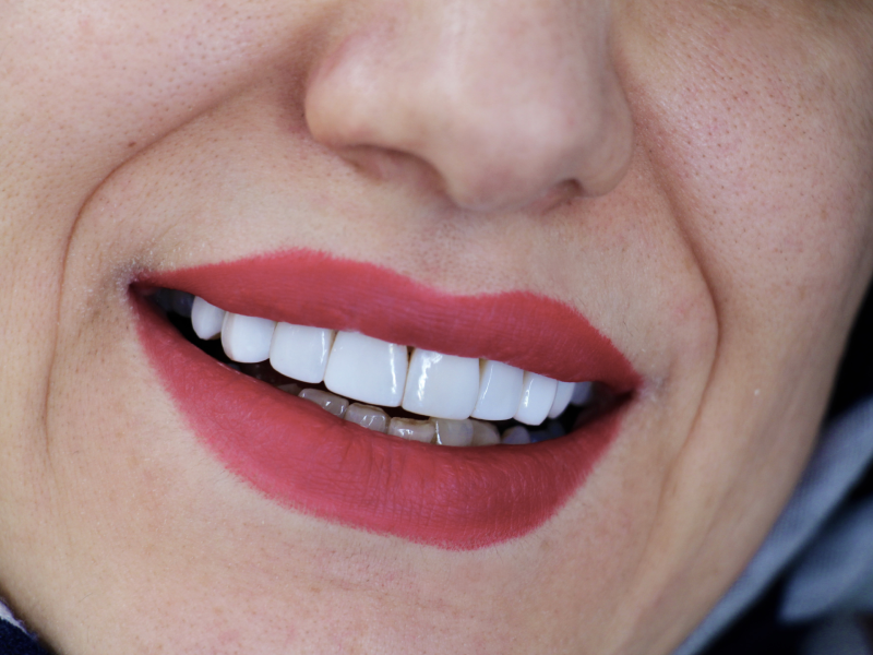 بهترین برند کامپوزیت دندان