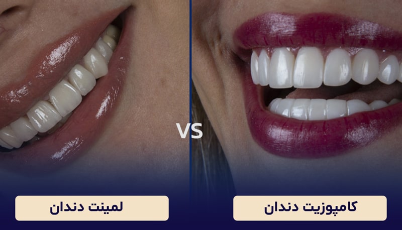 عکس لمینت و کامپوزیت دندان