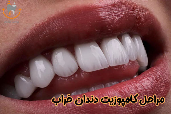 مراحل کامپوزیت دندان خراب