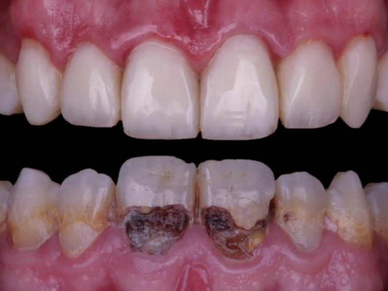 ایا دندان خراب را میشود کامپوزیت کرد