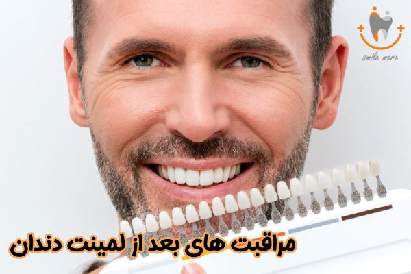 مراقبت های مهم بعد از لمینت دندان