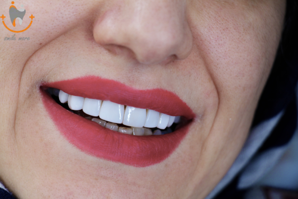 انواع کامپوزیت دندان2