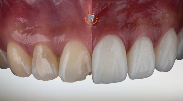فرق لمینت و کامپوزیت دندان