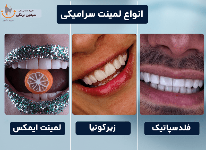 انواع لمینت سرامیکی