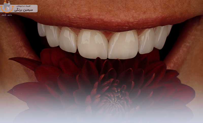 انواع لمینت سرامیکی