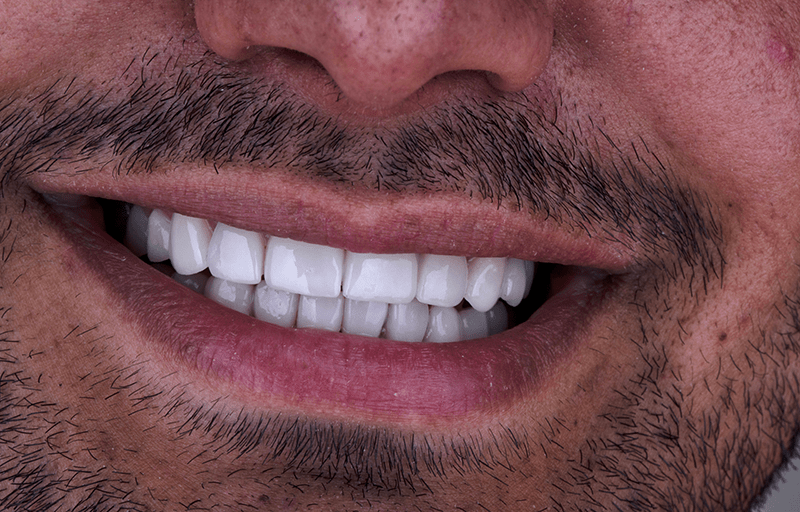 بهترین نوع لمینت سرامیکی دندان