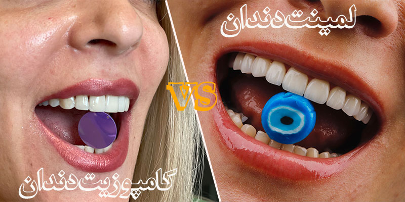 فرق کامپوزیت دندان و لمینت