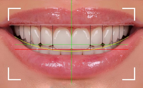 لمینت دندان چیست