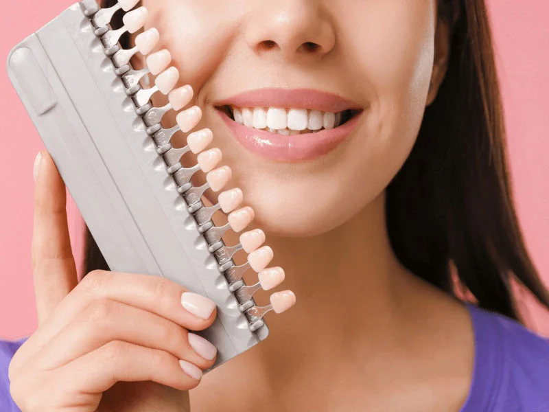 تفاوت لمینت و کامپوزیت دندان