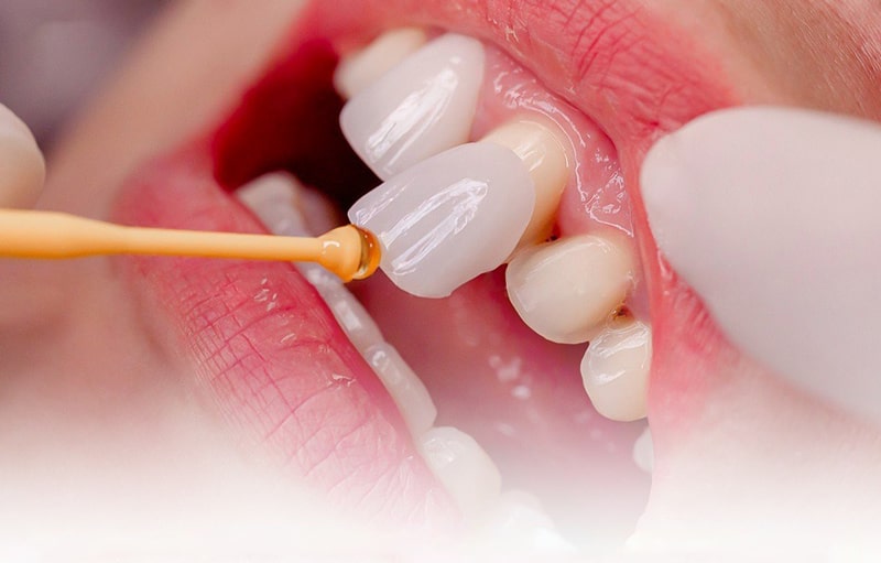 قیمت لمینت دندان بدون تراش