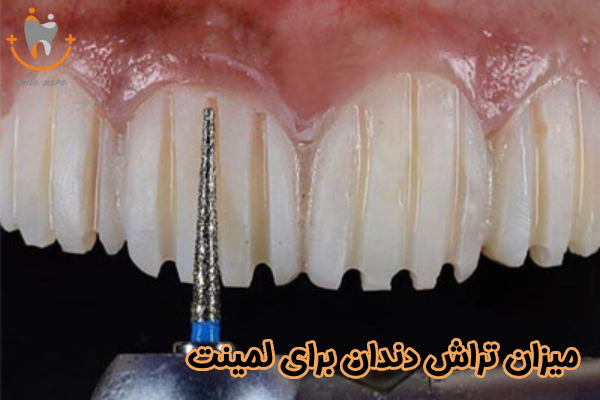 میزان تراش دندان برای لمینت
