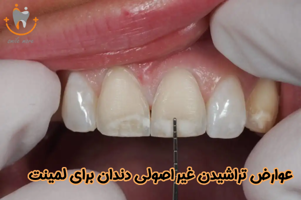 عوارض تراشیدن غیر اصولی دندان برای لمینت
