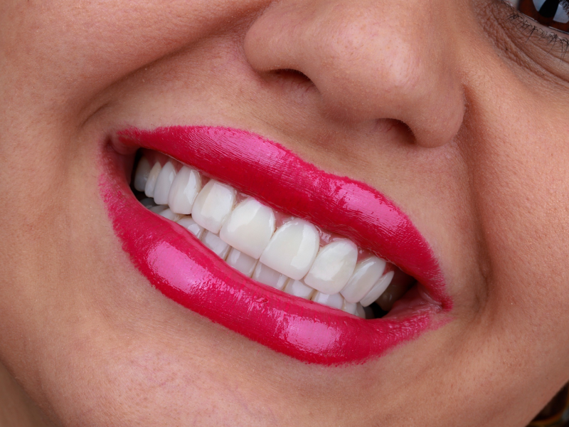 تعویض کامپوزیت دندان