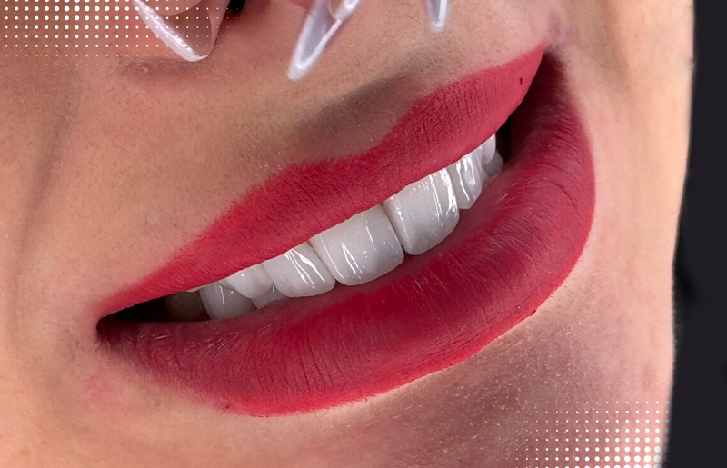 لمینت دندان بدون تراش در تهران