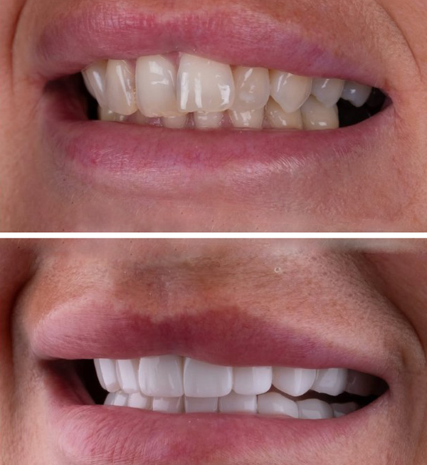 لمینت دندان بدون تراش