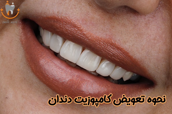 نحوه تعویض کامپوزیت دندان