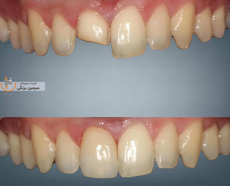 ترمیم لمینت دندان شکسته جلو