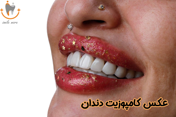 عکس کامپوزیت ونیر دندان