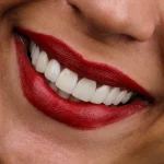 عکس کامپوزیت دندان