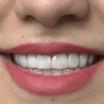 عکس کامپوزیت دندان11