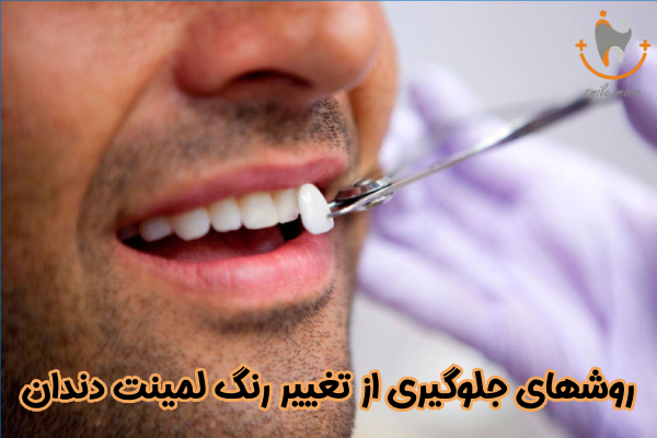 روشهای جلوگیری از تغییر رنگ لمینت دندان