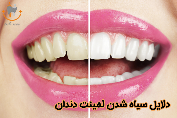 دلایل سیاه شدن لمینت دندان