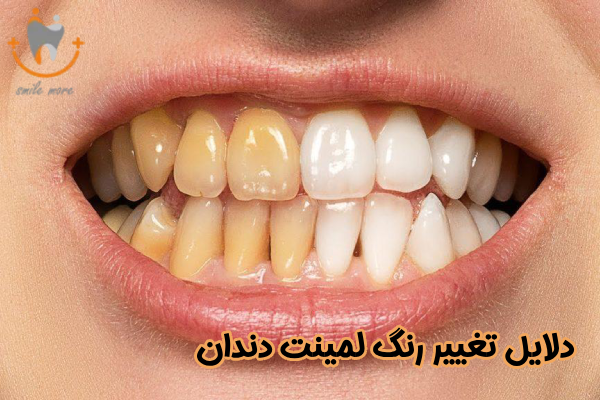 دلایل تغییر رنگ لمینت دندان