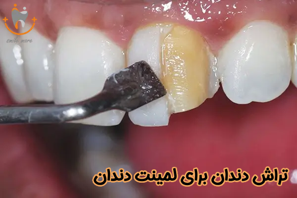 تراش دندان برای لمینت دندان