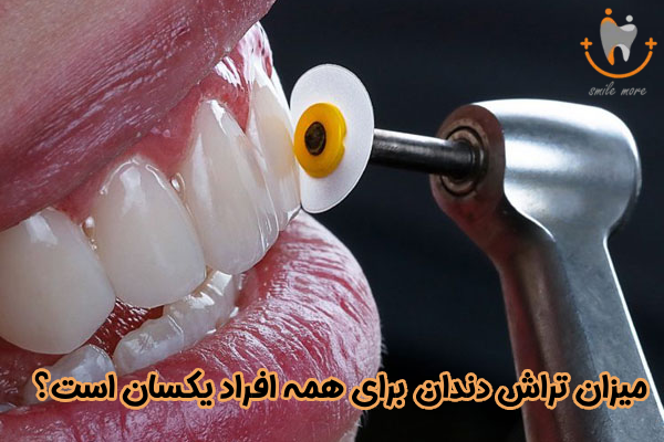 میزان تراش دندان برای همه یکسان است
