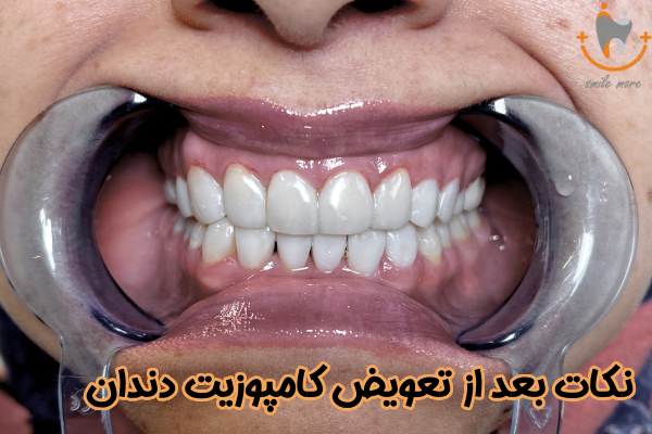 نکات بعد از تعویض کامپوزیت دندان