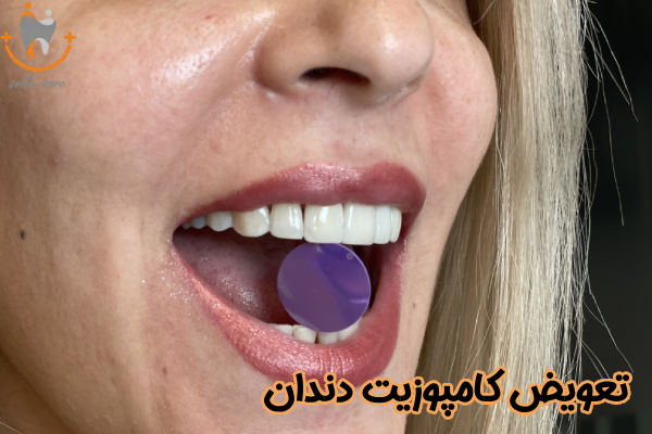 تعویض کامپوزیت دندان چیست؟