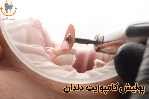 پولیش کامپوزیت دندان چیست