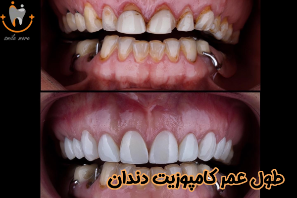 طول عمر کامپوزیت دندان چقدر است