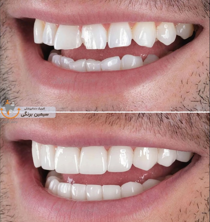 ترمیم لمینت دندان شکسته جلو