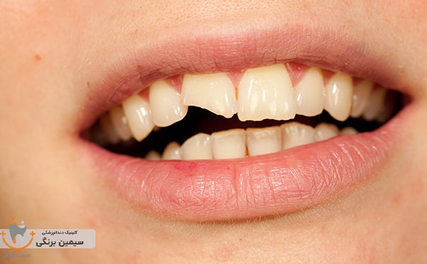 لمینت دندان شکسته جلو