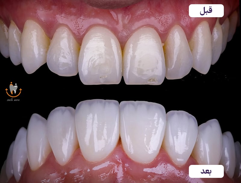 عکس قبل و بعد پولیش دندان